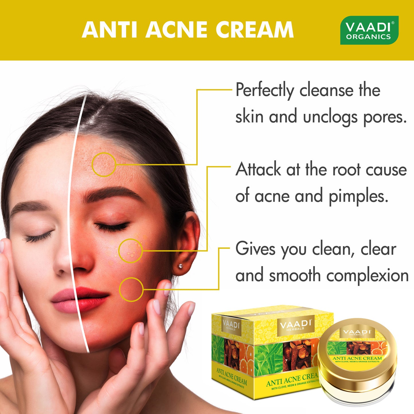 Pack of 3 Anti-Acne Cream - Clove & Neem extract (30 gms x 3)