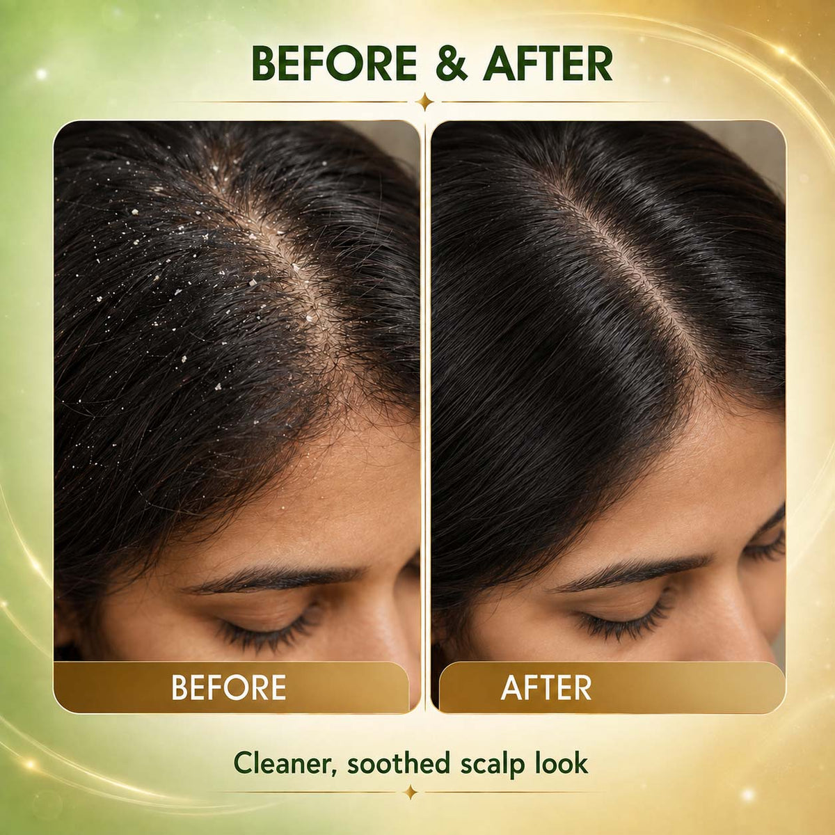 3% SALICYLIC ACID + 1% PIROCTONE OLAMINE ANTI DANDRUFF HAIR SERUM (30 ml)