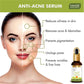 Anti-Acne Serum With Glycolic & 2% Salicylic Acid (30 ml)